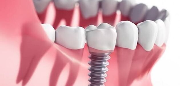 Things to Know About Dental Implant Surgery