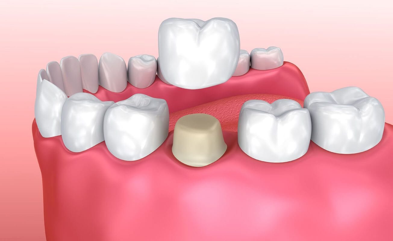 Dental Crowns and Bridges Treatment in Wadgaon Sheri