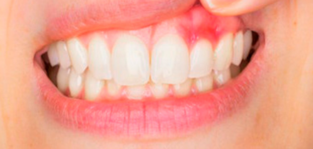 Bleeding Gums And Its Causes and Treatment