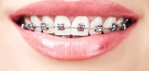 5 Things To Keep In Mind When Considering Braces