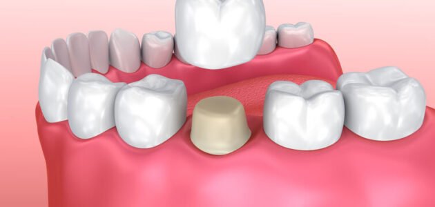 How Long Should Porcelain Veneers Last?