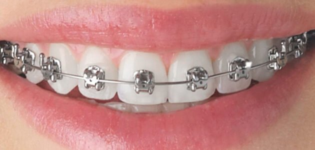 5 Things To Keep In Mind When Considering Braces