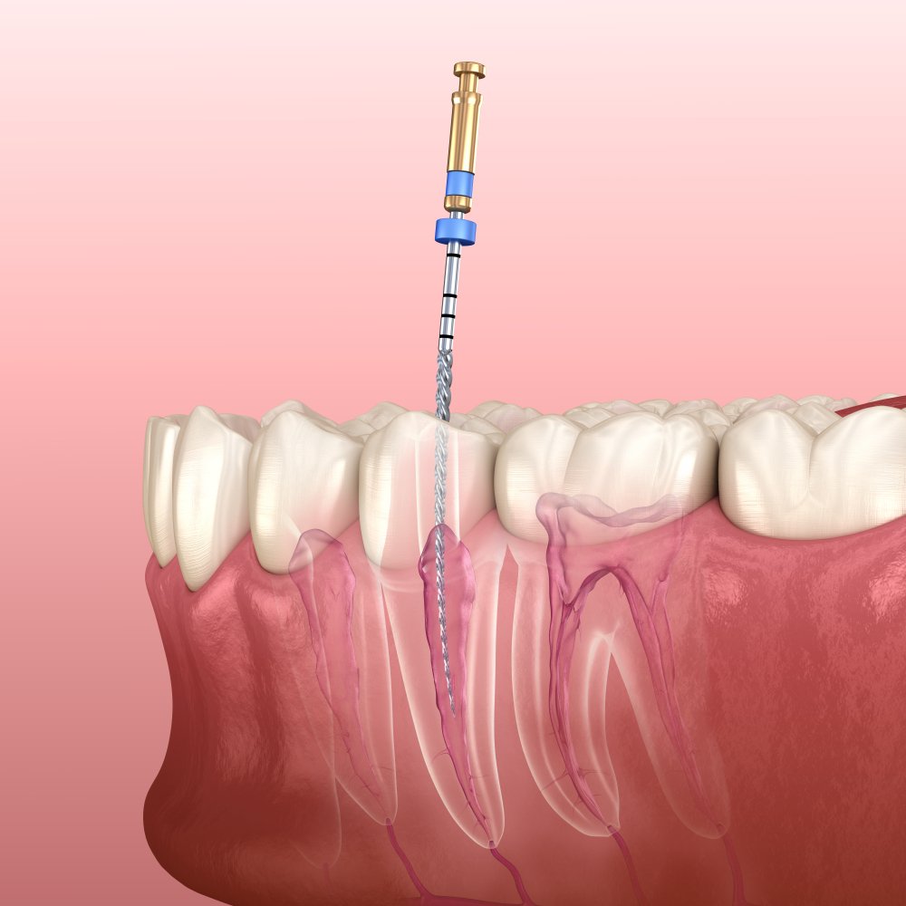 Painless Root Canal Treatment in Kalyani Nagar Pune