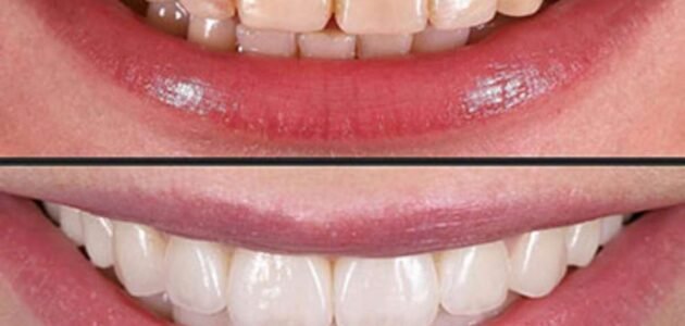 Porcelain Veneers Without the Drill