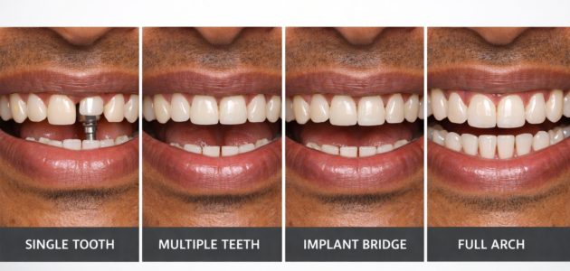 How Many Missing Teeth Can One Implant Fix?