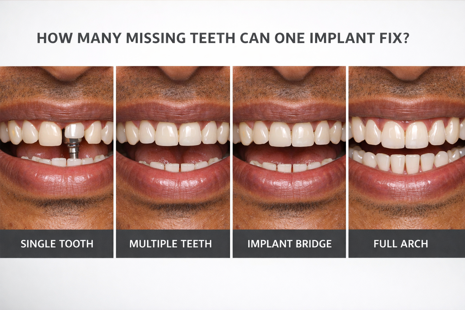 Find dental implant solutions for multiple missing teeth with Dr. Amit Thareja at Dr. Tharejas Dental Clinic