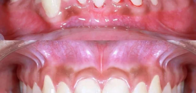 Pinhole Gum Surgery vs Gum Grafting: Which is Better?