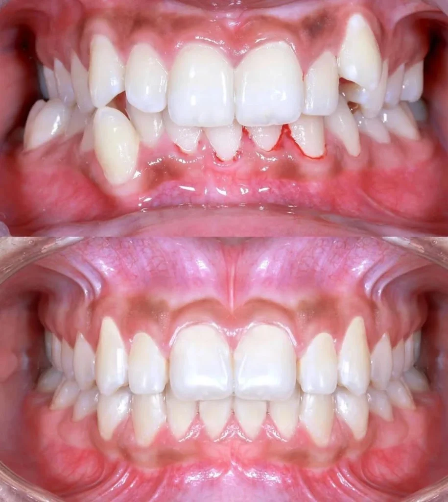 Find gum recession treatment options by Dr. Amit Thareja comparing pinhole vs grafting.