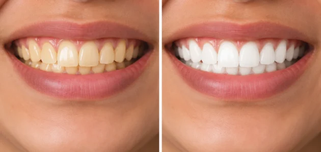 How to Whiten Yellow Teeth for Long-Lasting Results